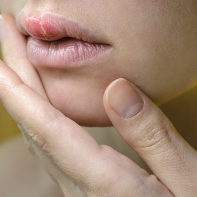 Herpes On The Upper Lip Of A Young Woman Herpes On The Upper Lip Of A Young Woman